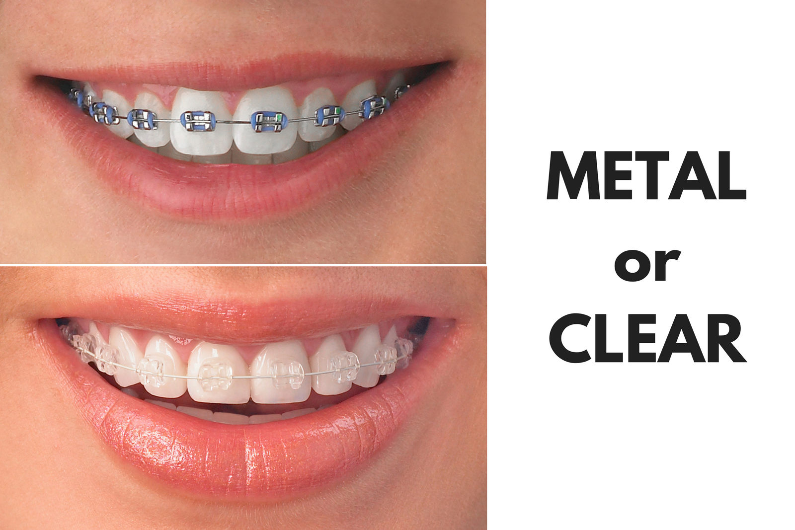 Ask Your Smyrna Dentist: Should I Get Metal or Clear Braces?