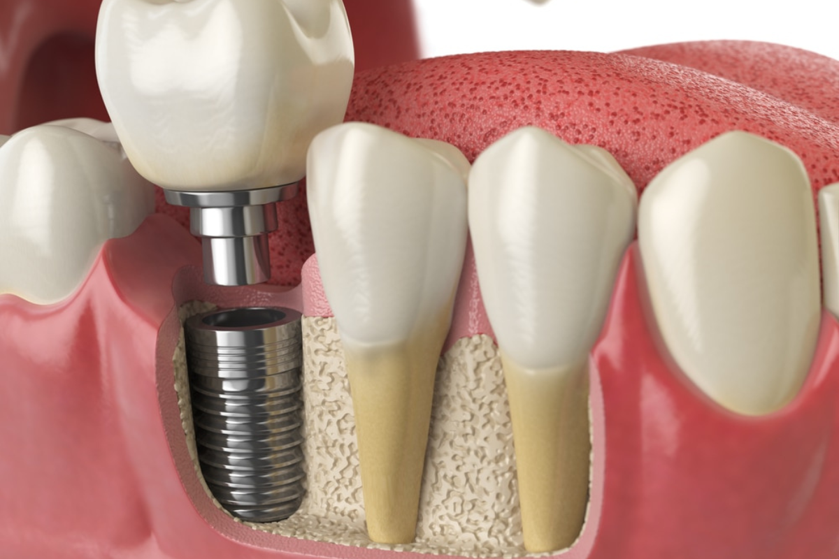 How Long Do Dental Implants Last?