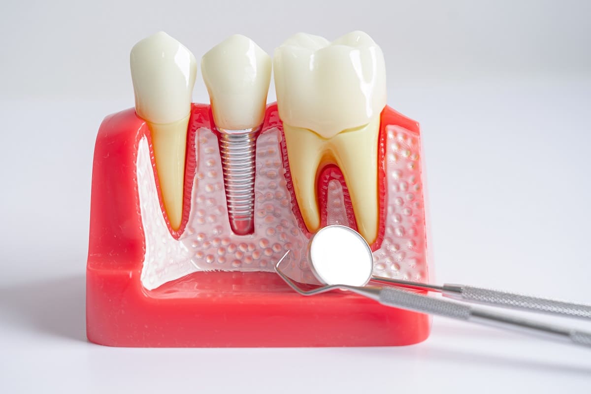 how to choose a dental implant dentist