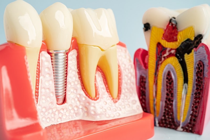 missing several teeth replacement options in Smyrna