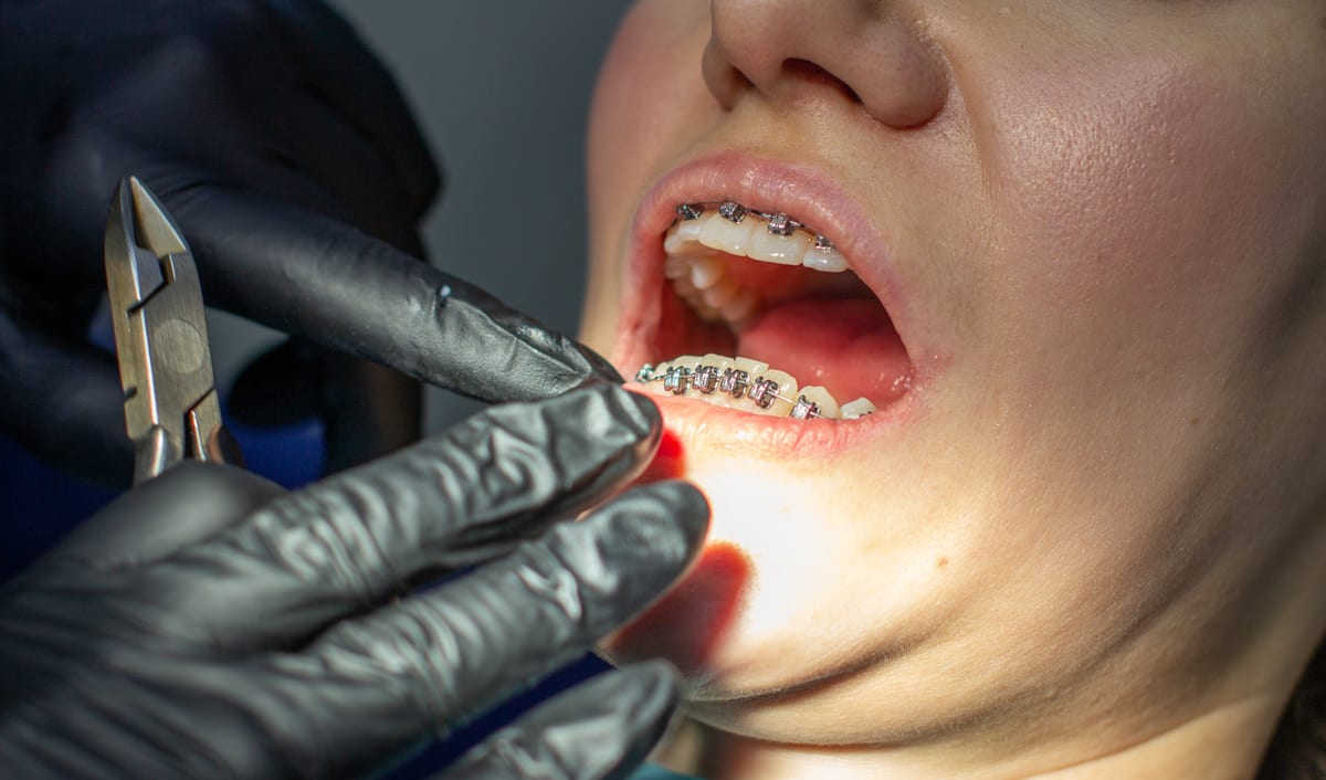 Tooth-Colored Fillings in Smyrna